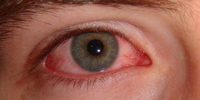 bệnh đau mắt đỏ lây qua đường nào và cách chữa trị